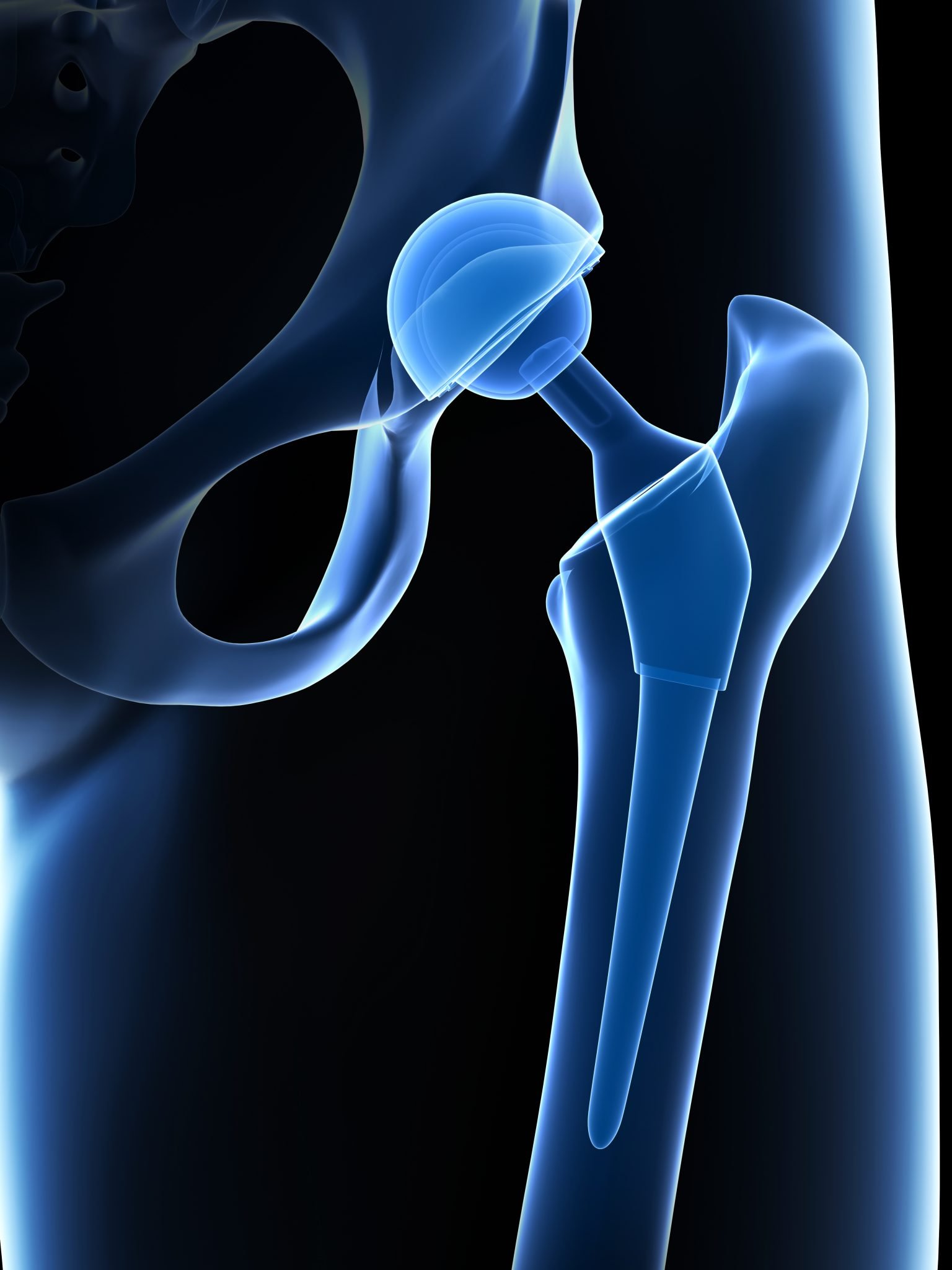 depuy hip implant lawsuit