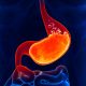 stomach paralysis