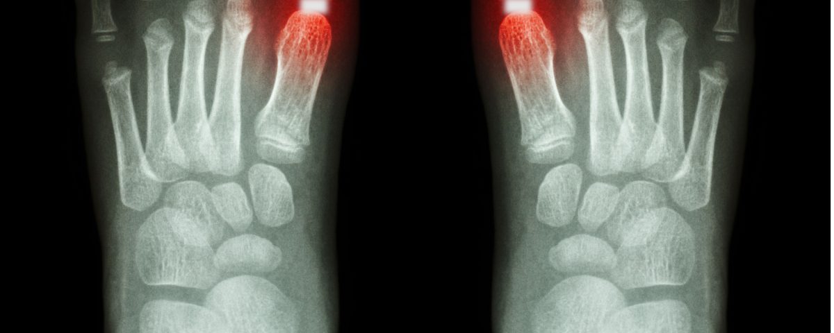 Cartiva Implant Lawsuit
