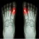 Cartiva Implant Lawsuit