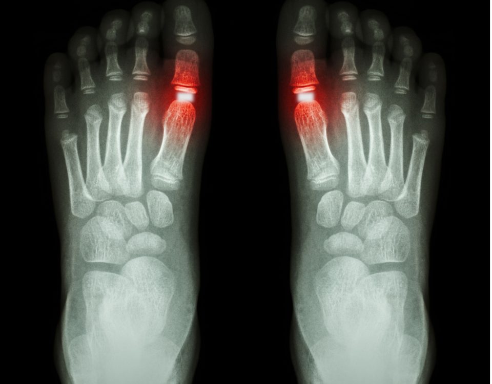 Cartiva Implant Lawsuit