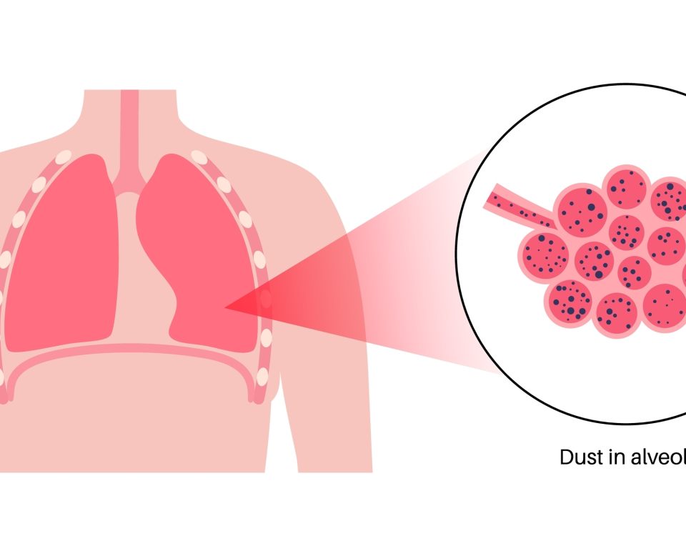 Silicosis Lawsuit Silica Lung Diseases
