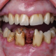 Suboxone tooth decay
